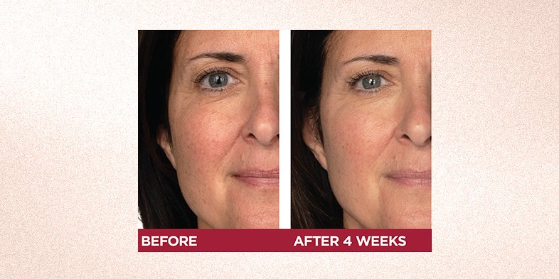 Before and after using product to reduce smile lines